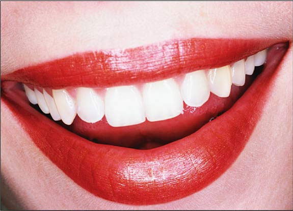 España, atrasada en cuanto a la blanqueamientos dentales en casa