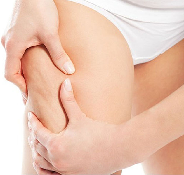 ¿Es la celulitis un factor hereditario? 