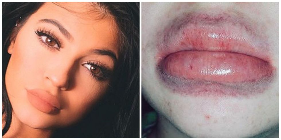 trucos para conseguir labios de kylie jenner