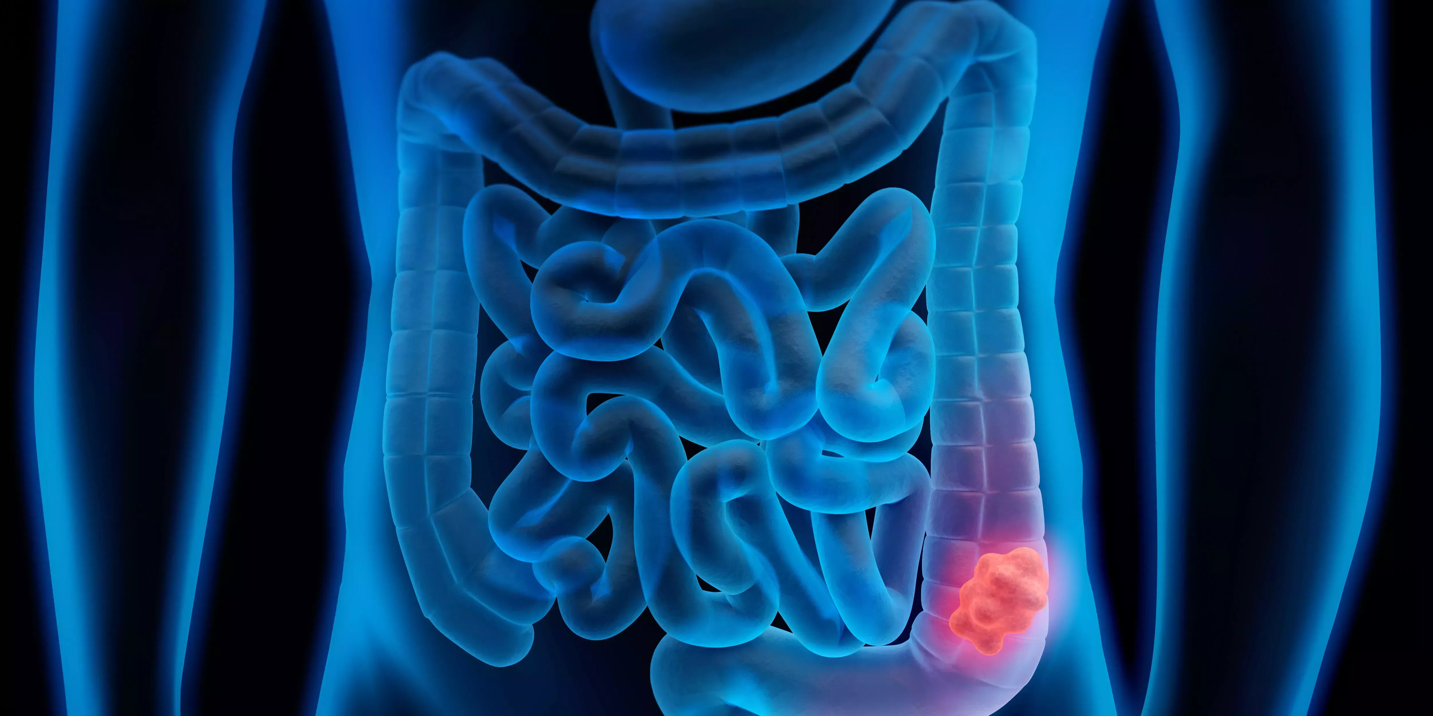8 factores de riesgo de cáncer de colon, desde la dieta hasta los hábitos de consumo, según un médico