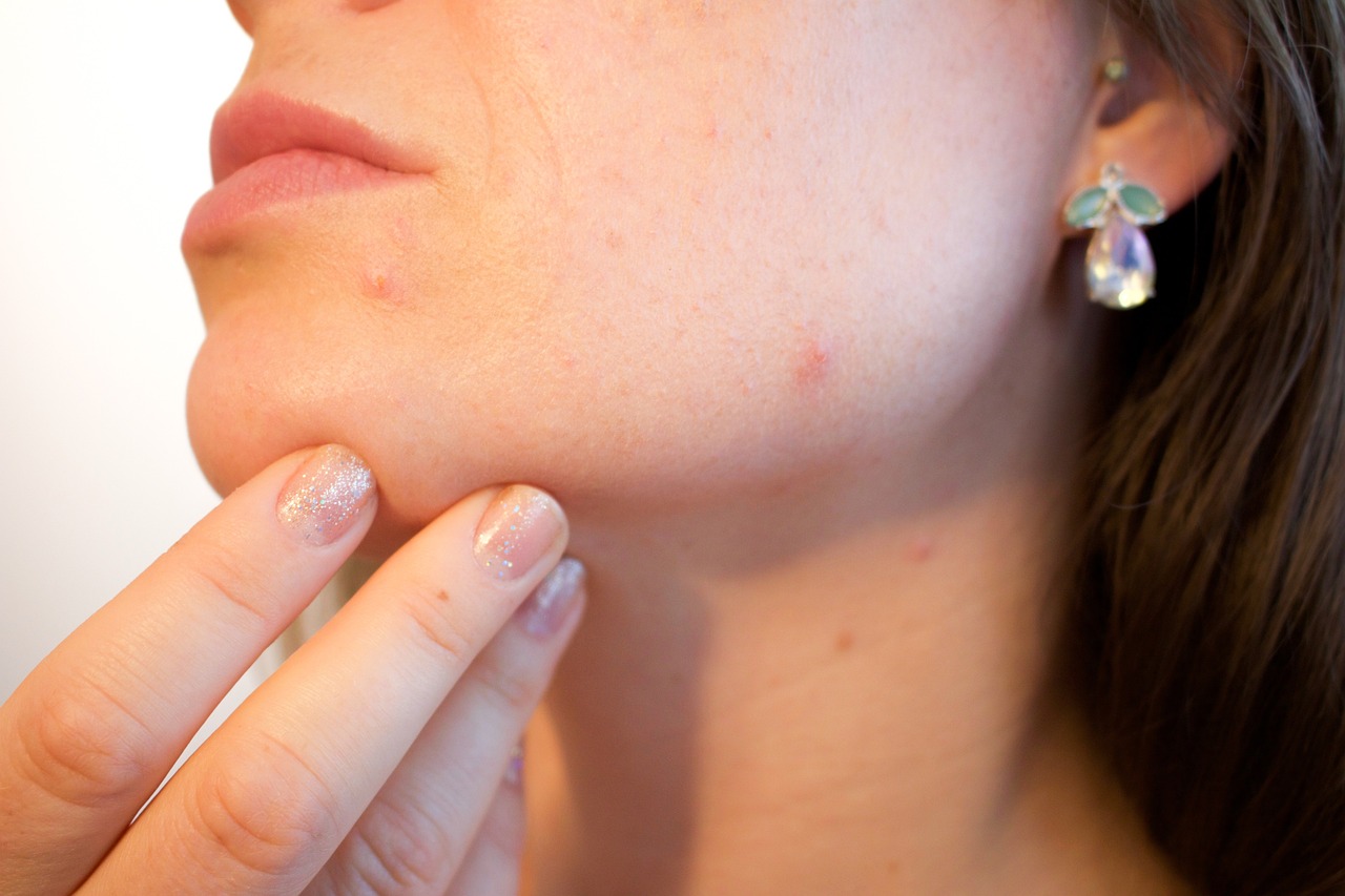 ¿Qué puede causar granos en la cara?