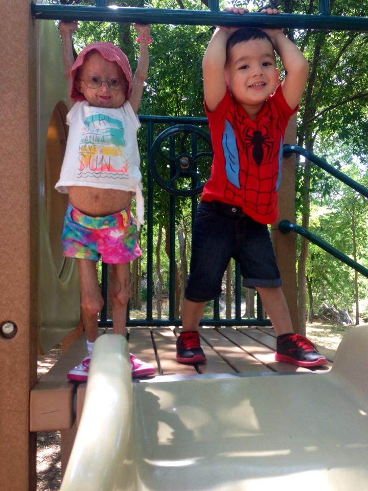 Adalia Rose, niña con envejecimiento prematuro