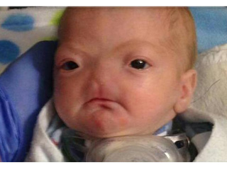 Eli Thompson, bebé sin nariz