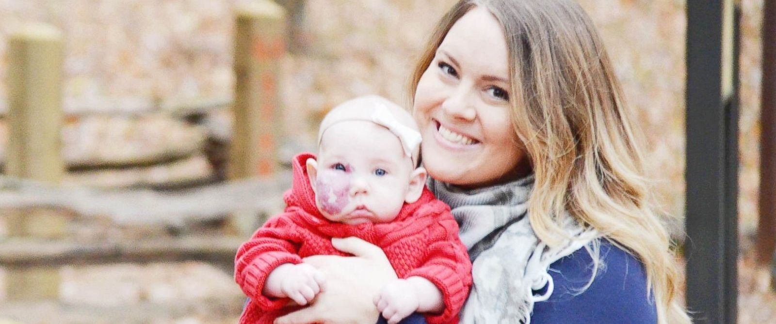 Niña con mancha de nacimiento en la cara