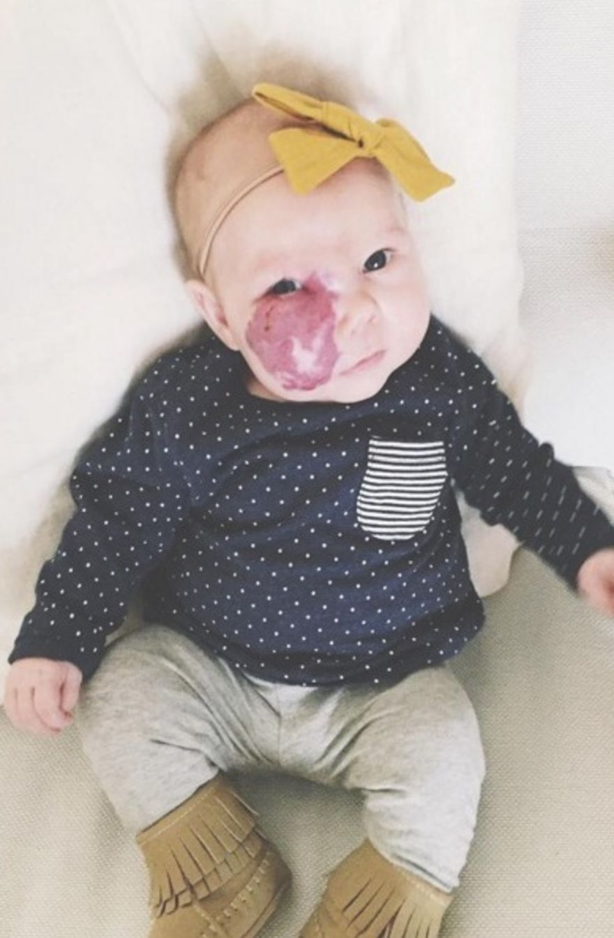 Niña con mancha de nacimiento en la cara