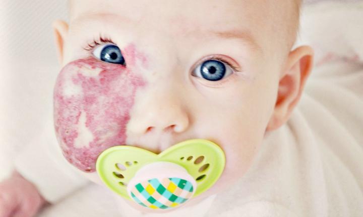 Niña con mancha de nacimiento en la cara