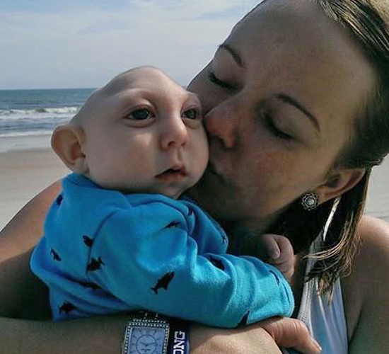 Jaxon Buell, el bebé sin cráneo ni cerebro