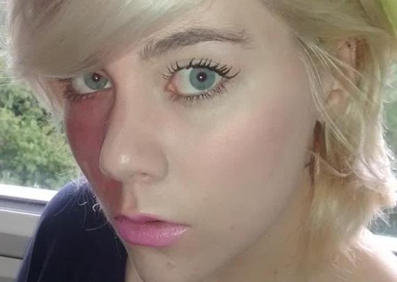 Chica con mancha de nacimiento en la cara