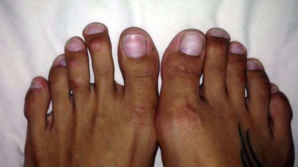 Cirugía de Cenicienta