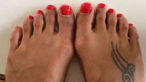 Cirugía de Cenicienta