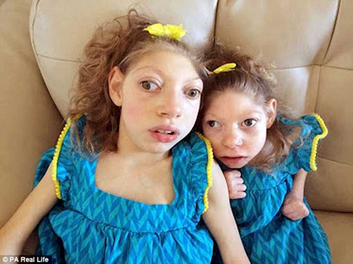 Hermanas con extraña enfermedad