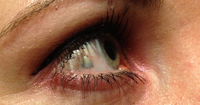 Implantes de joyas en los ojos
