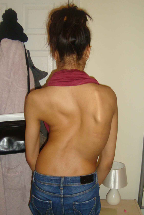 Ayesha Jones modelo con escoliosis