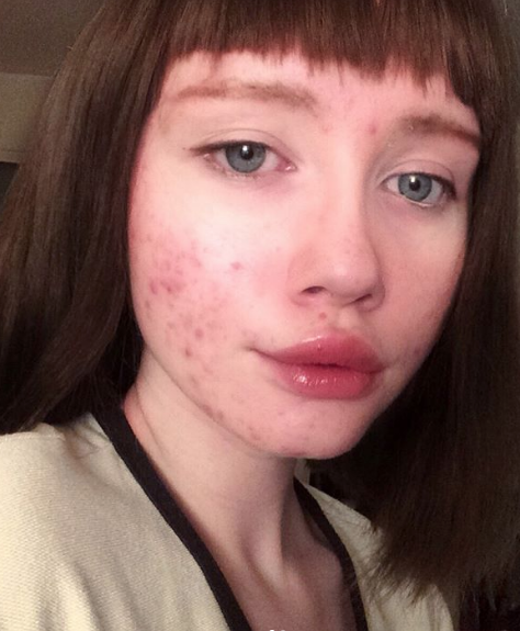 La instagramer Hailey Wait muestra su acné para luchar contra el canon de belleza