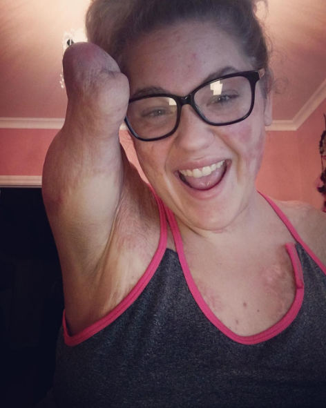 Kaitlyn Dobrow, bloguera sin extremidades