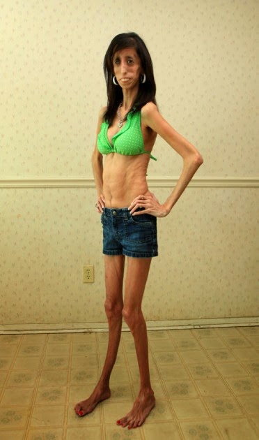 Lizzie Velasquez, 'la mujer más fea del mundo'