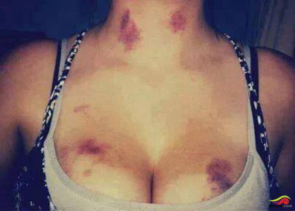 Chupetones peligrosos