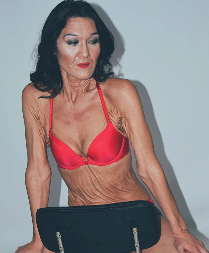 Sara Geurst, mujer de 26 años con arrugas en la piel 