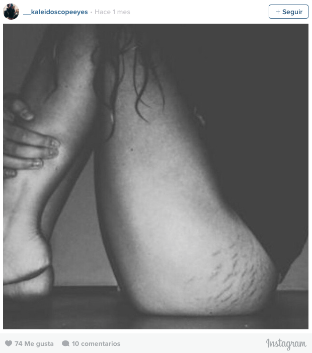 #LoveYourLines, mujeres con estrías