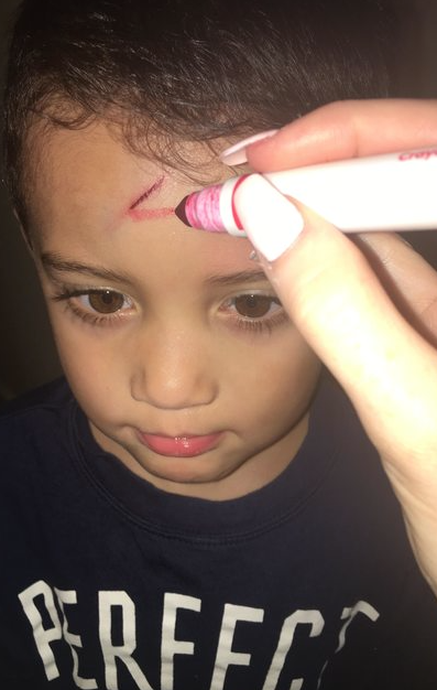 Así arregló esta madre la cicatriz de su hijo