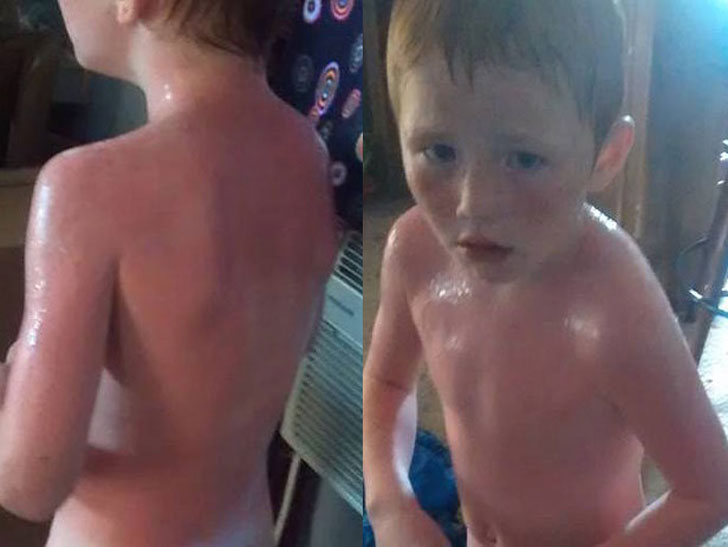 Niños con quemaduras solares