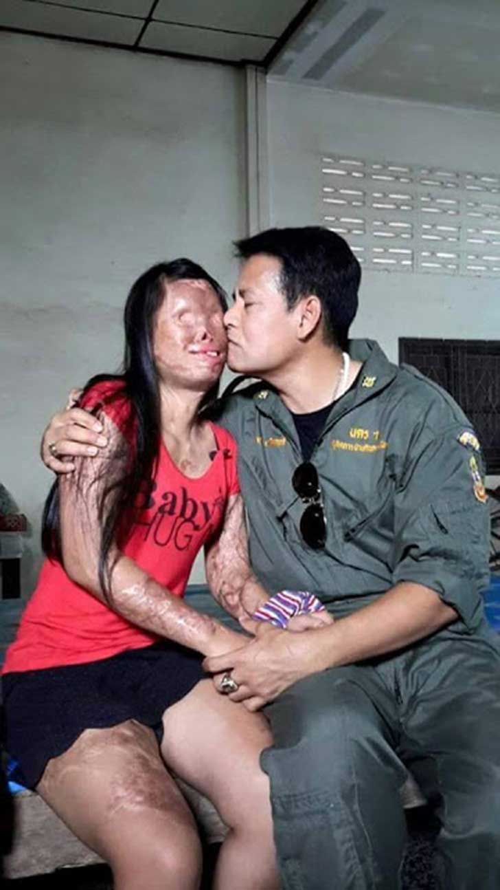 Novia desfigurada en un accidente