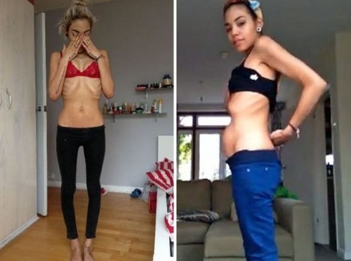 Holly Griffith, madre con pregorexia