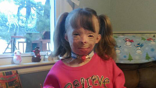 Niña quemada en un incendio pide tarjetas por Navidad