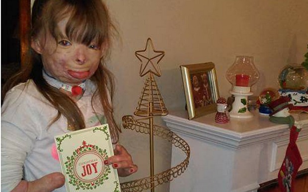 Niña quemada en un incendio pide tarjetas por Navidad