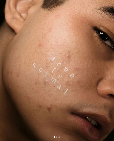 Selfies con acné #skinpositive