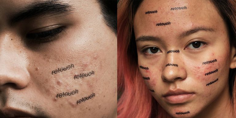 Selfies con acné #skinpositive