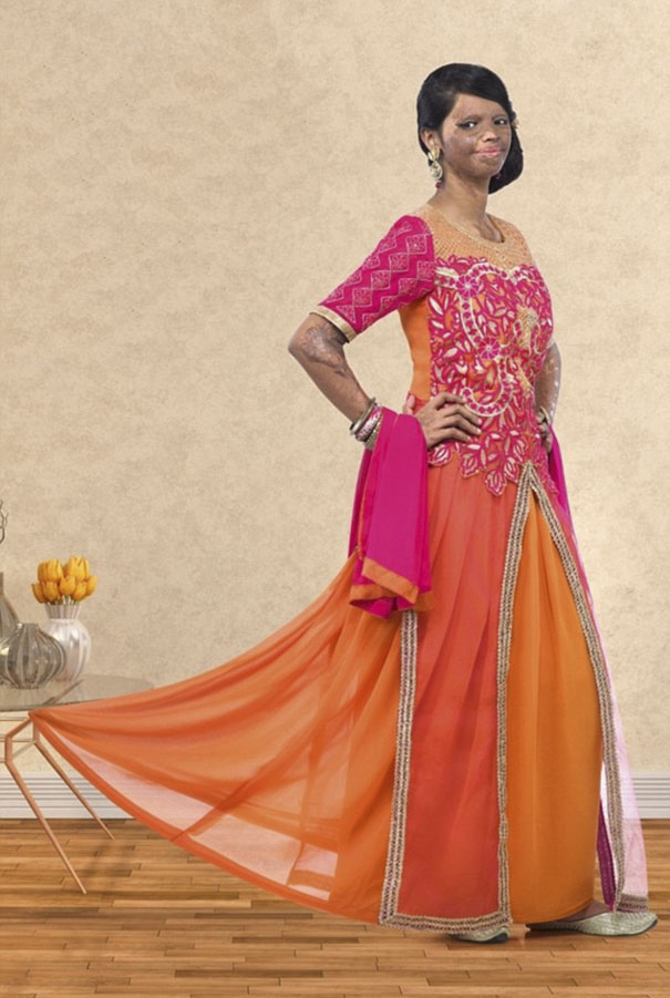 Superviviente a un ataque de ácido se convierte en modelo