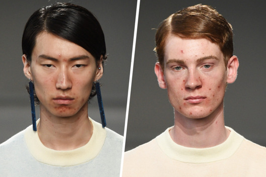 Modelos con acné en el desfile de Moto Guo