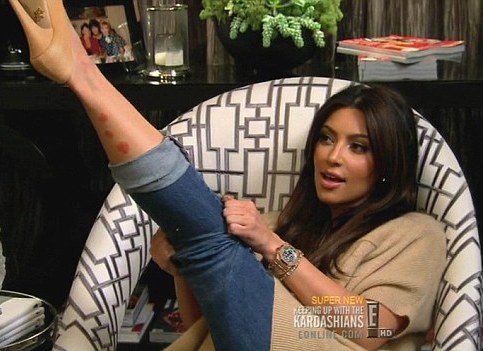 ¿Sabías que Kim Kardashian sufre psoriasis?