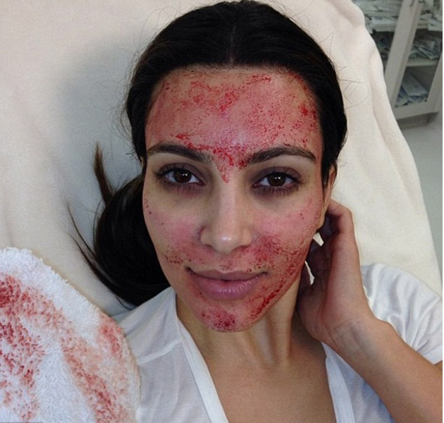 Kim Kardashian se somete a un tratamiento de belleza muy sangriento 