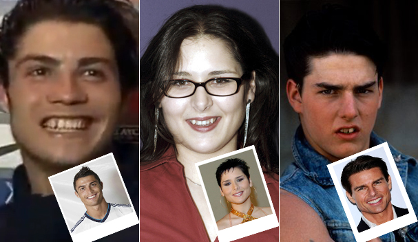 Fotos de famosos antes y después de operarse los dientes