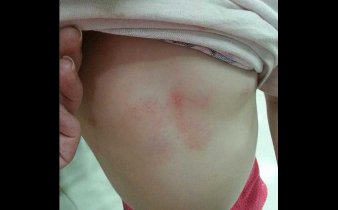 accidente de trafico niña hematomas