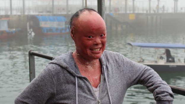 Así es vivir con la piel en carne viva