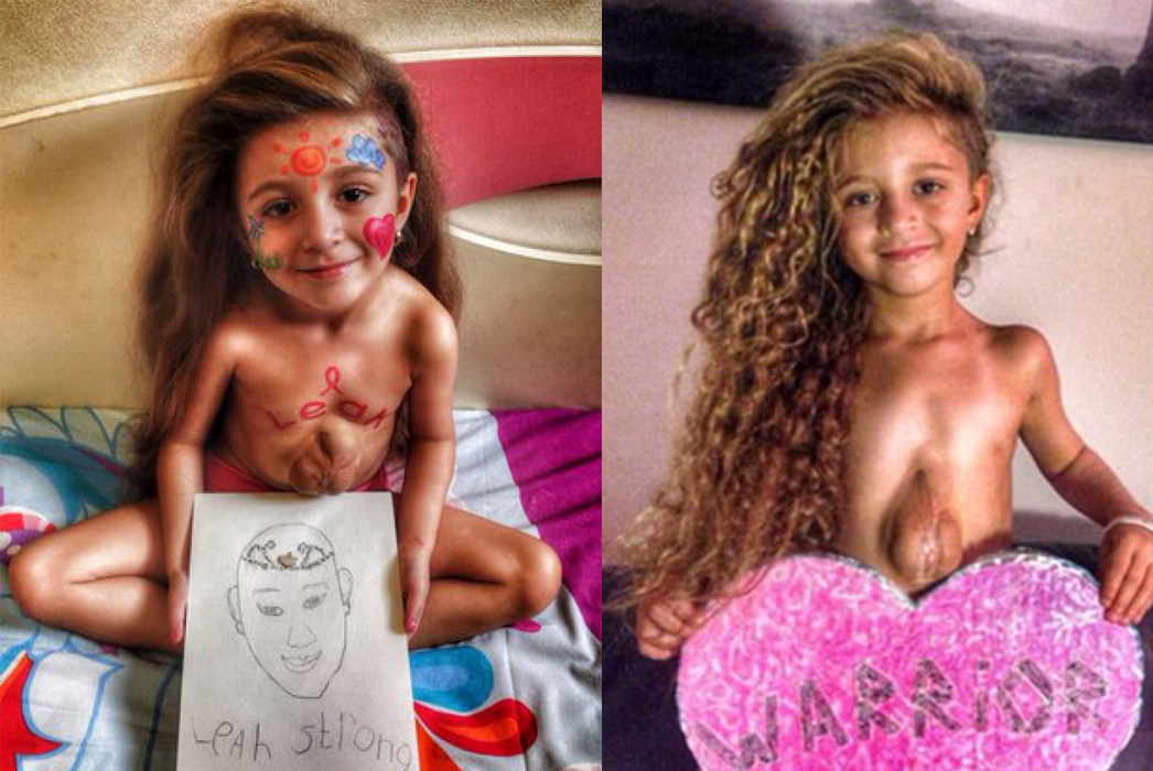 Esta niña nació con el corazón fuera del pecho