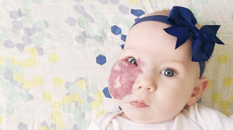 bebe con mancha en la cara