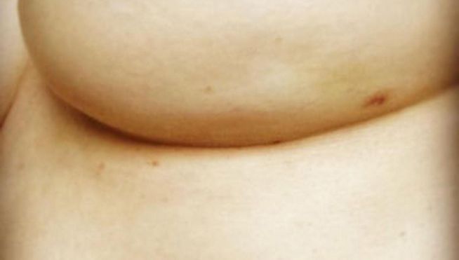 Este es un síntoma del cáncer de mama que quizás no conozcas