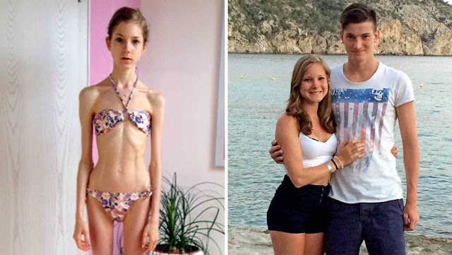 amor anorexia