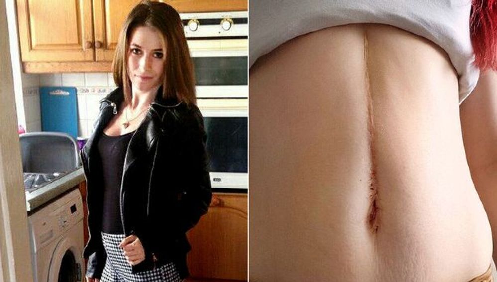 bola de pelo estomago 