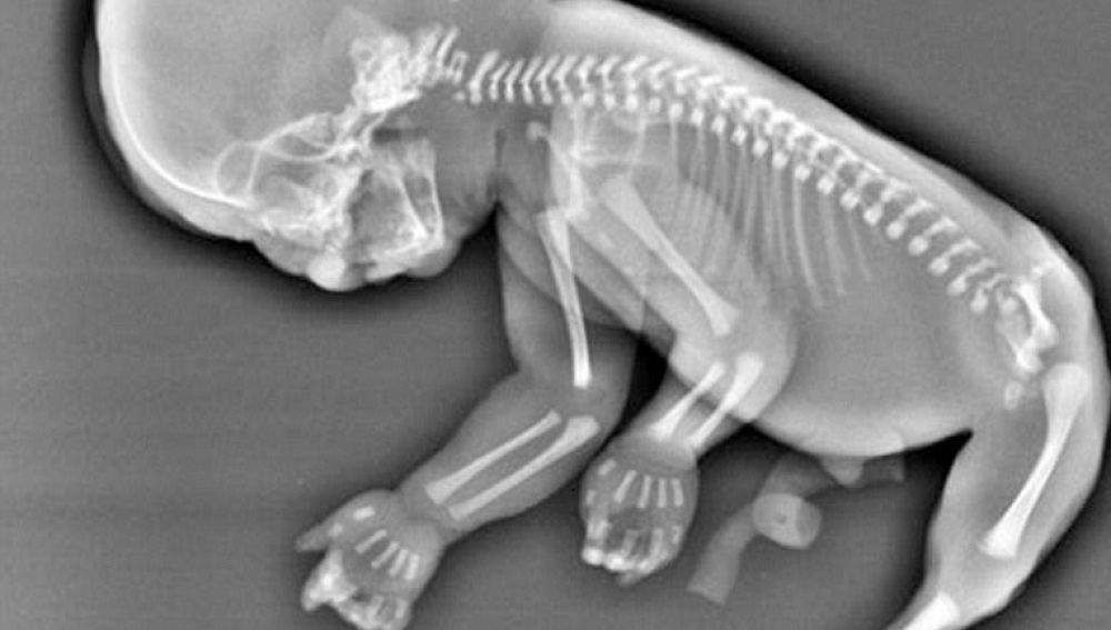 sindrome de la sirena