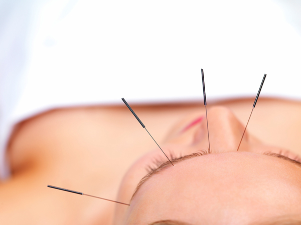 acupuntura para adelgazar