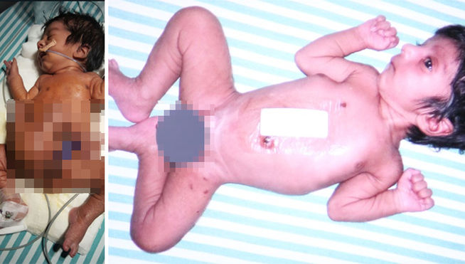 bebe con cuatro piernas y dos penes