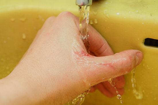 que hacer cuando te quemas