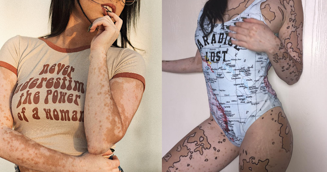 vitiligo obras de arte piel