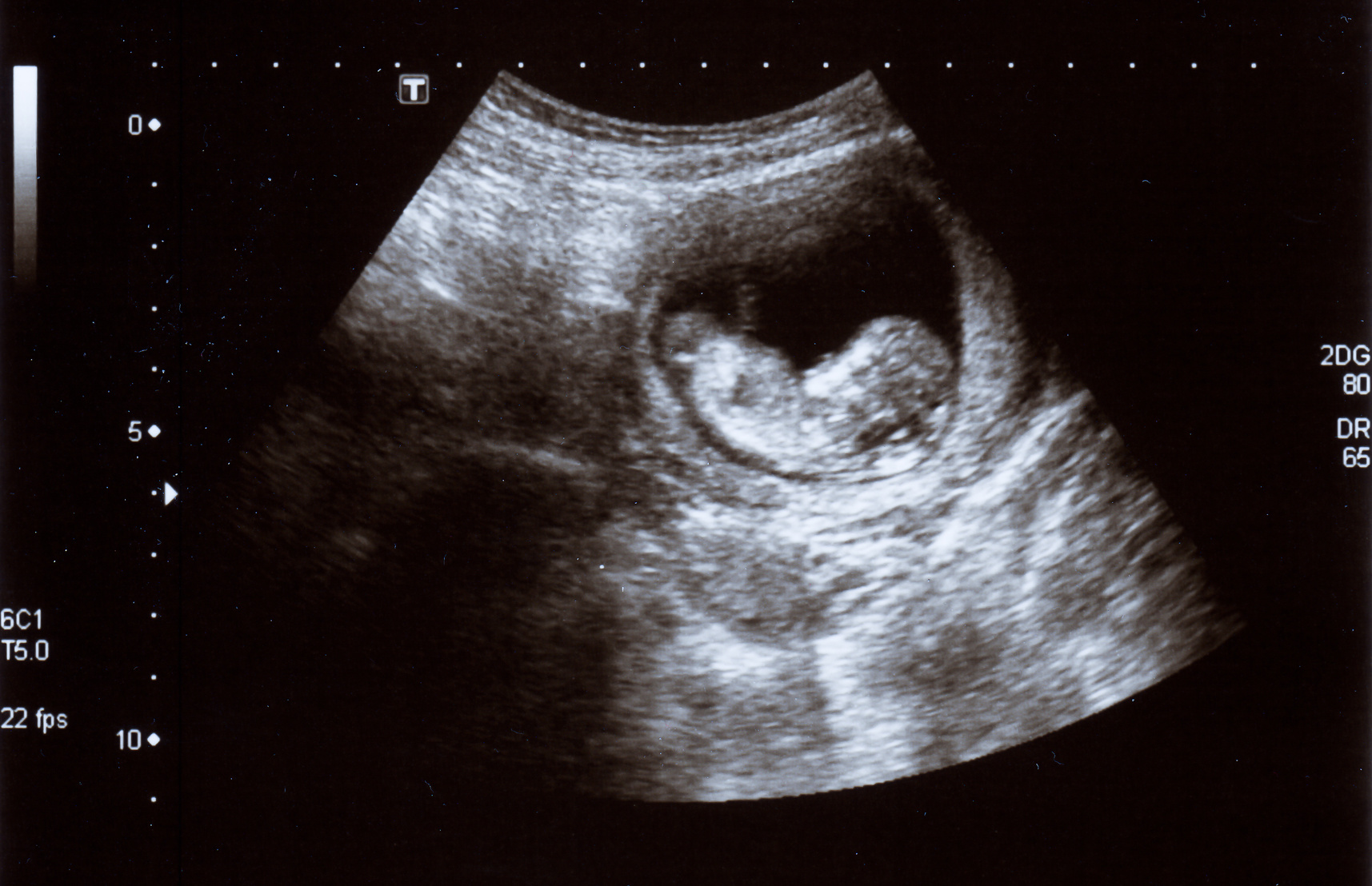 Muere una mujer después de abortar cuatro veces en menos de un año