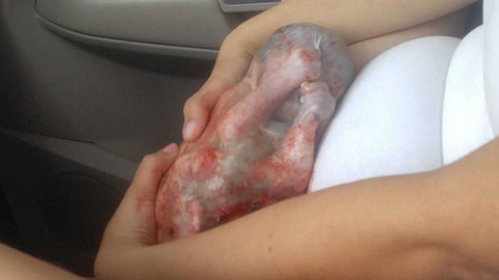 Sobrevive un bebé pese a nacer prematuro, en un coche y en su saco amniótico
